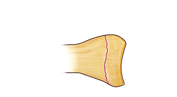 Salter I Fracture - Fracture line through growth plate (physis) but non displaced