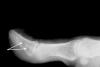 Squamous cell carcinoma X-ray right thumb with bone involvement (arrows).