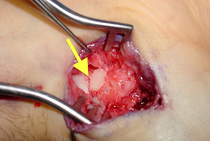 Scaphoid Fracture (arrow on fracture line) exposed volubly for ORIF