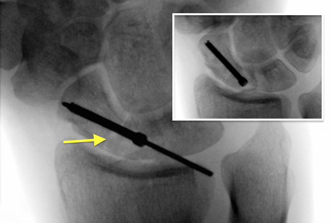 Trans-Scaphoid Perilunate Fracture /Dislocations ORIF with a screw.