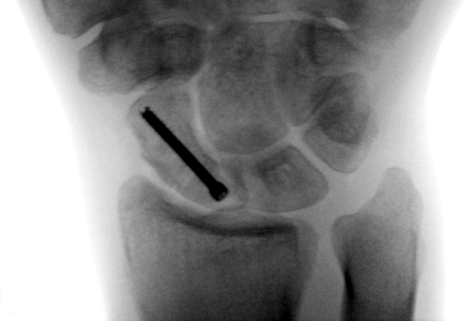 Screw fixation (ORIF) of proximal scaphoid fracture