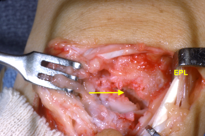 Scaphoid non-union (arrow) after removal of fibrous union (arrow) EPL noted.