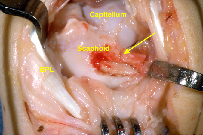 Scaphoid non-union (arrow) with a dorsal Russe bone graft in place.