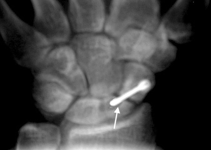 Failed right scaphoid non-union treatment with a headless screw. Note widen fracture site and micro motion of proximal screw tip.