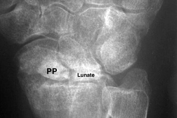 Chronic severe scaphoid non-union with marked proximal pole AVN (PP) and lunate AVN and arthritis.