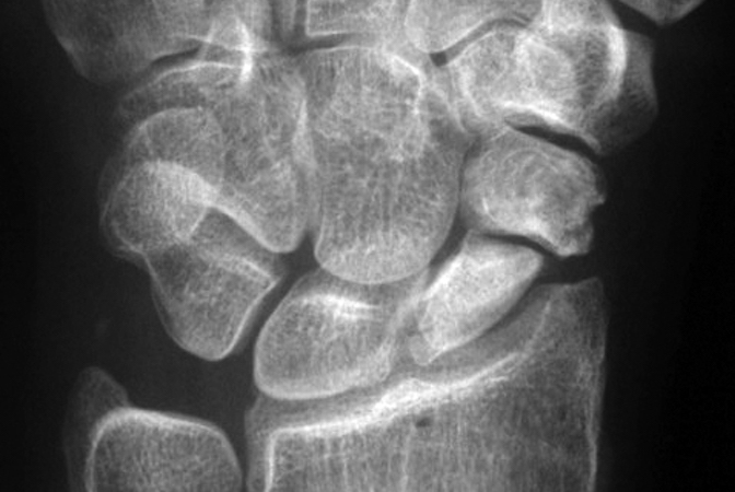 Chronic left scaphoid non-union with pseudoarthrosis. Note deformed proximal pole with possible AVN.