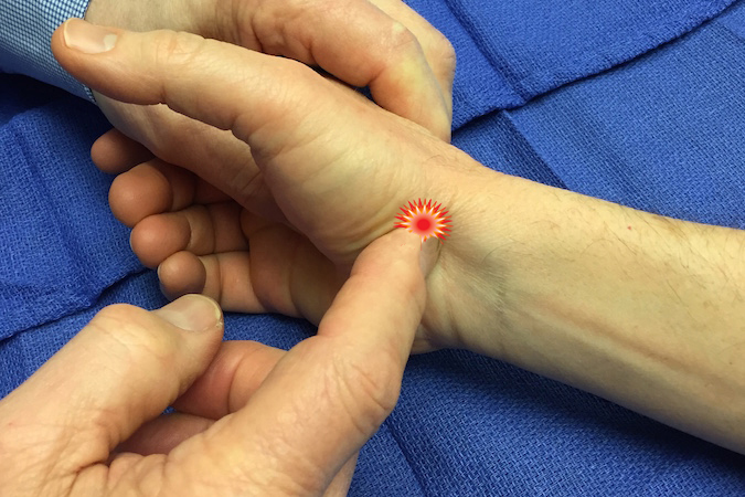 The patient with a scaphoid fracture also presents with scaphoid tuberosity tenderness