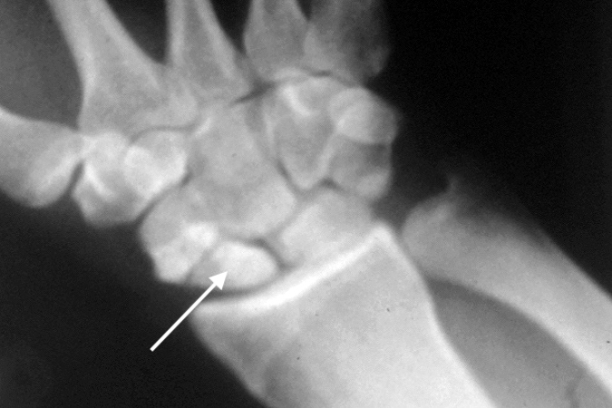 Right scaphoid non-union with AVN (arrow).