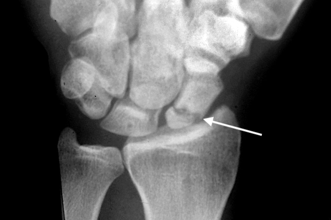 Left proximal pole scaphoid non-union (arrow)