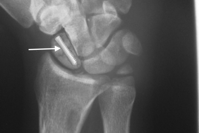 Right scaphoid non-union with headless screw (arrow)  and graft in place. Note excellent alignment of scaphoid fracture.