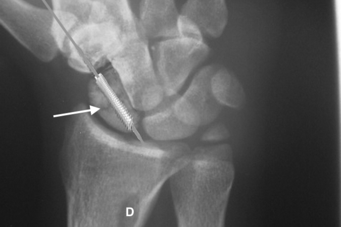 Right scaphoid non-union (arrow) with guide pin and headless screw in place.