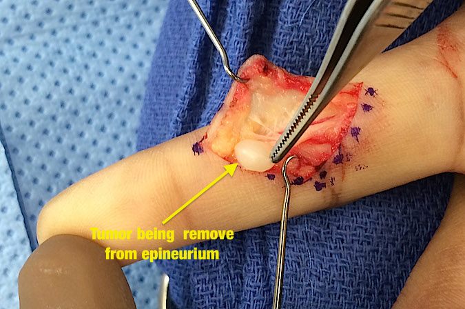 Case 2 - Schwannoma radial digital nerve of the index finger. 