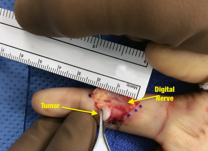 Case 2 - Schwannoma radial digital nerve of the index finger. Schwannoma removed (in forceps).  Note radial digital nerve intact but a hole remains between the fascicular groups.