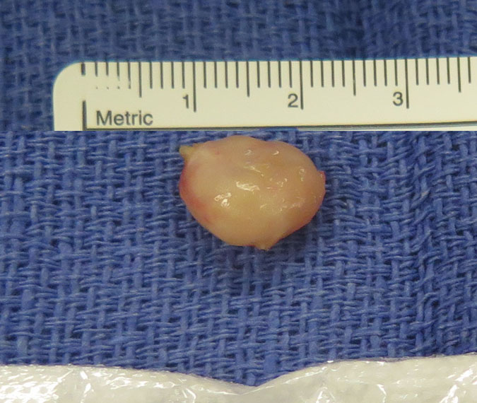 Excised Neurilemmoma (Schwannoma)