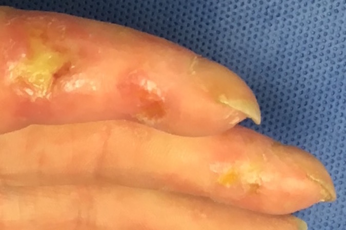 Chronic digital trophic changes secondary to scleroderma