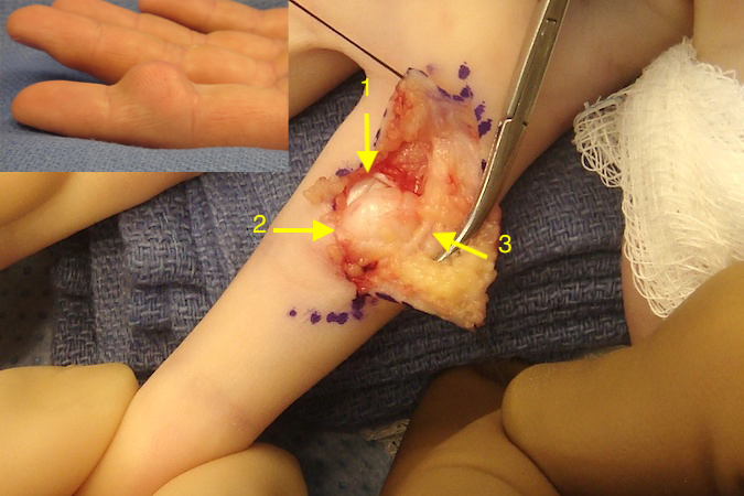 Left index sebaceous cyst (insert).  1 - flexor tendons and sheath;  2 - note imitate adherence of cyst wall to epidermis;  3 - digital nerve.