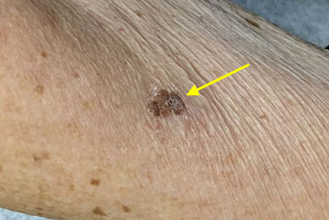 Seborrheic keratosis of dorsal ulnar left hand (arrow).