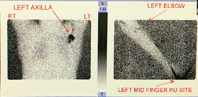 Imaging after injection for a sentinel node biopsy of patient with a subungual melanoma left long finger.  Note uptake in left axilla.