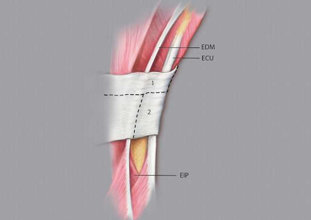 Extensor retinaculum incisions for exposing the DRUJ.  Extensor tendons labeled.