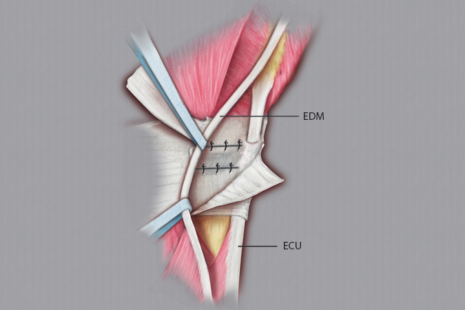 Closure of the capsular incisions in the DRUJ and RC joints.