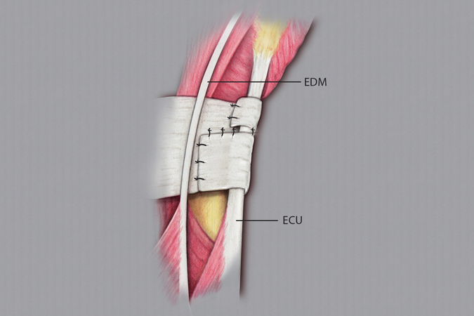 Closure of the extensor retinaculum and ECU sheath reconstruction.