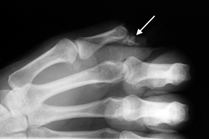 Thumb amputation through IP joint area (arrow). Note distal phalanx fragments still attached to the volar plate.