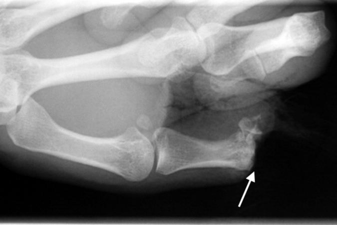 AP X-ray of thumb amputation through IP joint area (arrow). Note distal phalanx fragments still attached to the volar plate.