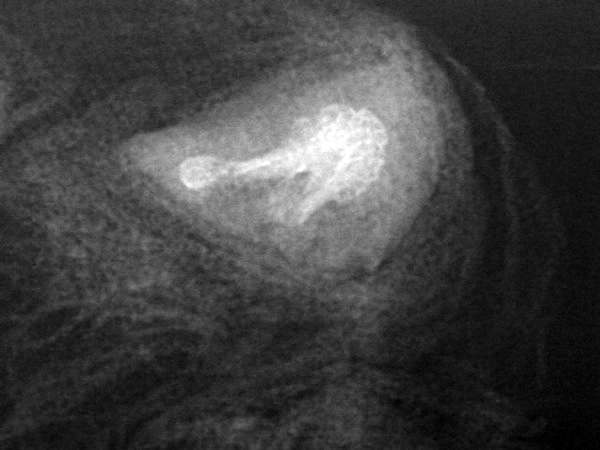 X-ray of thumb amputated part through IP joint area.  Part x-rays very important when assessing replantation options.  Note significant bone loss from the distal phalanx.
