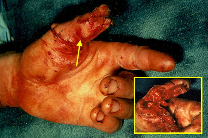 Mangled partial thumb amputation saved by revascularization of volar flap. (arrow)