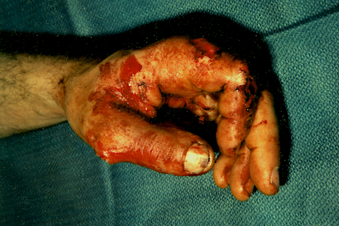 Dorsal view of partial thumb amputation saved by revascularization.