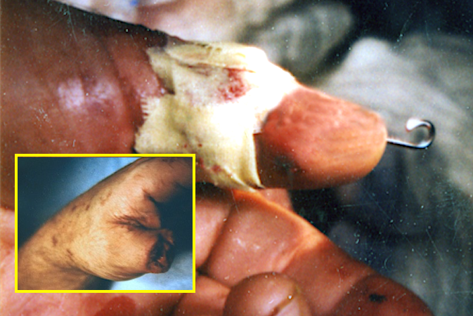 Thumb amputation through distal proximal phalanx treated by replantation.