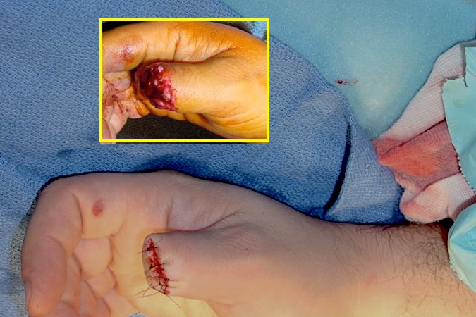 Primary revision of a crush avulsion thumb amputation through the proximal phalanx.