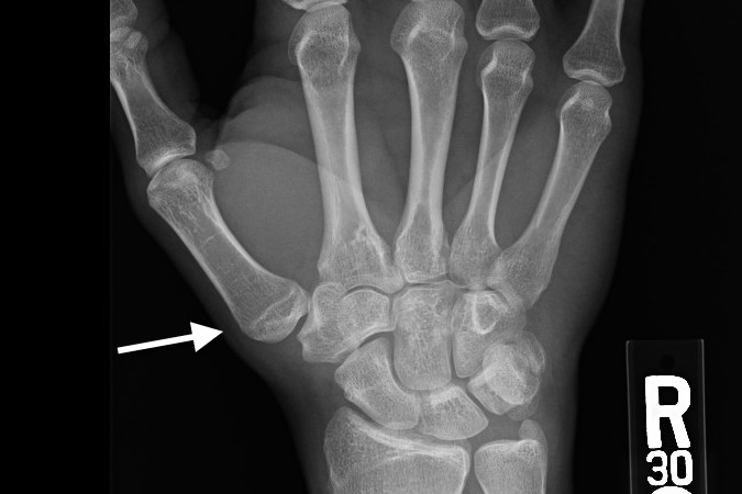 Two years before thumb injury negative wrist X-ray shows normal metacarpal base (arrow)