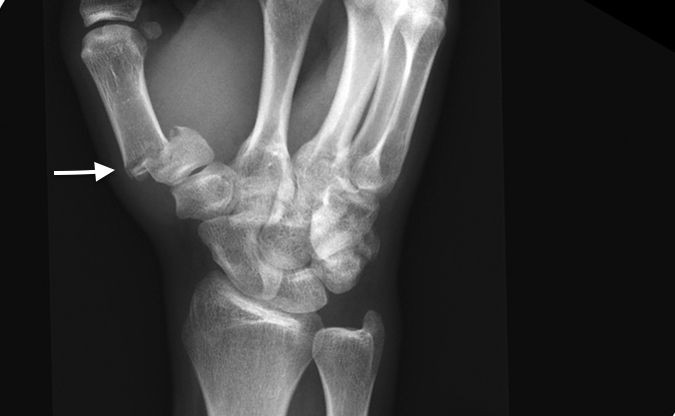 Two years after negative wrist X-ray 18 y.o. male falls and sustains a displaced extra-articular (AP) base fracture (arrow).