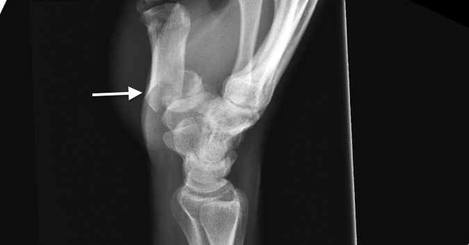 Two years after negative wrist X-ray 18 y.o. male falls and sustains a displaced extra-articular (Lateral view) base fracture (arrow).