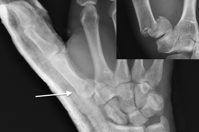 Thumb metacarpal base fracture anatomically reduced (arrow) under local block and splinted.