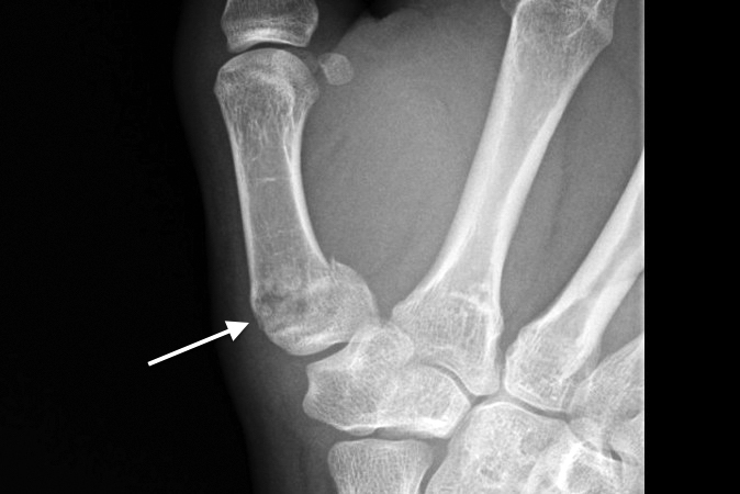 Thumb metacarpal base fracture healed anatomically (arrow) at 8 weeks.
