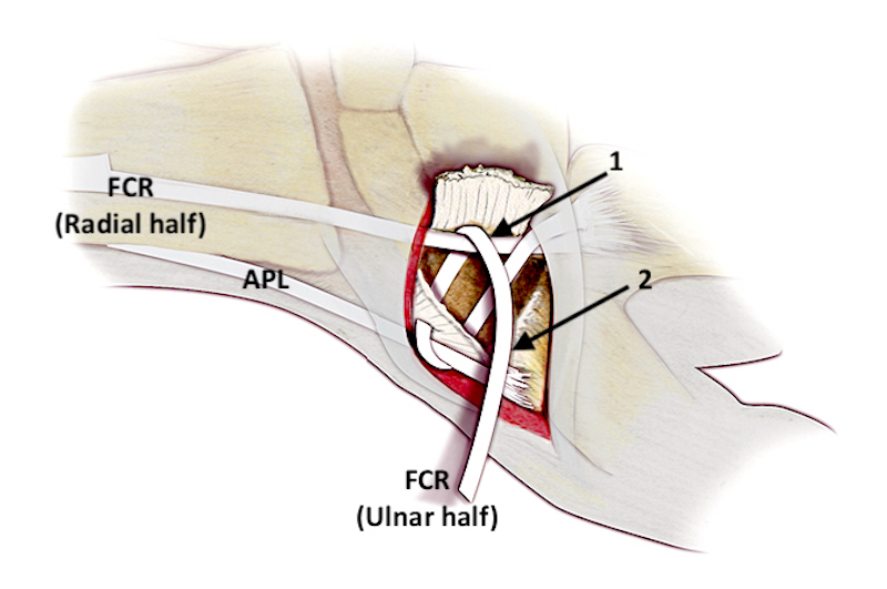 The ulnar half of the FCR is shown going back through the dorsal radial capsule slightly more proximally and around the intact radial half of the FCR (1). Next the ulnar half of the FCR goes to the dorsal radial corner of the capsule again where it is sutured (2).