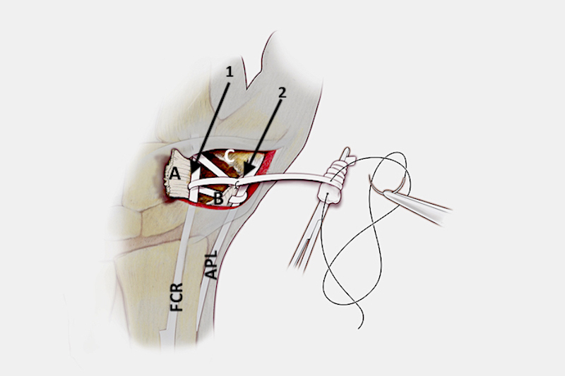 Next the remaining ulnar half of the FCR is sutured into a ball "anchovy" with 2-O chromic suture.  This fascial material is secured to the radial half of the FCR inside the defect made from the earlier trapezial excision.  The fascia acts as a temporary spacer to support the thumb metacarpal. After the fascia is packed into the defect, the capsule edge "A" is sutured to "B" and to the base of the  metacarpal "C".  Prior to making the fascial ball the FCR maybe extended with a palmaris longus tendon graft.