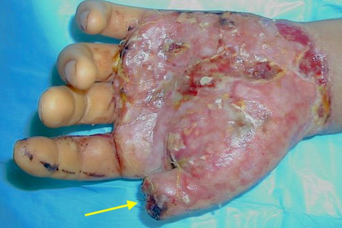 Thumb tip amputation with palm devolving injury treated thinning reattaching  of the palmar flap and amputation revision.