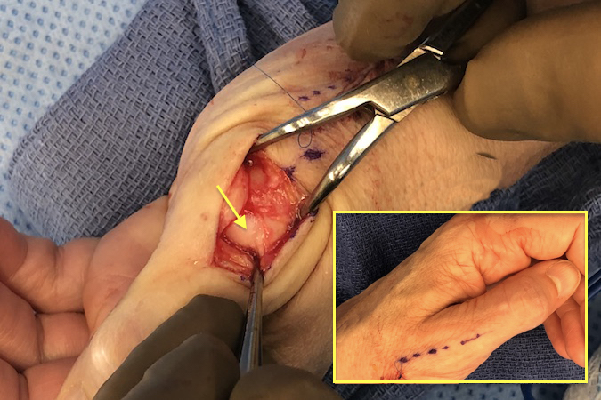 Dorsal incision is used to open the EPL/EPB interval and MP capsule.  The metacarpal head cartilage is exposed (arrow).