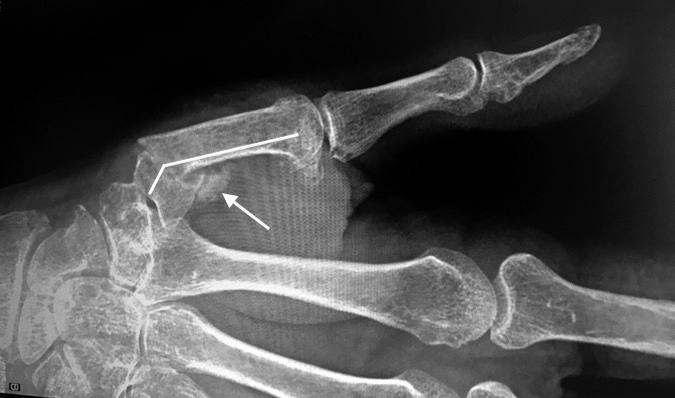 Elderly medically disabled male with angulated healed base of metacarpal fracture with no complaints.