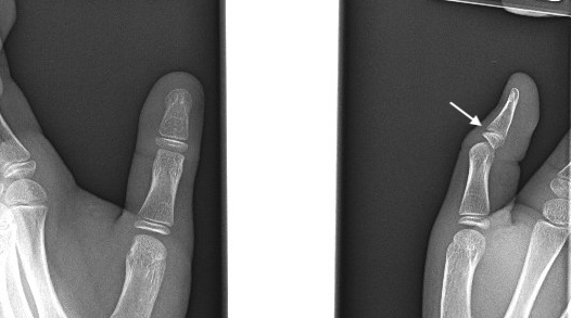 Thumb distal phalanx angulated Salter I fracture