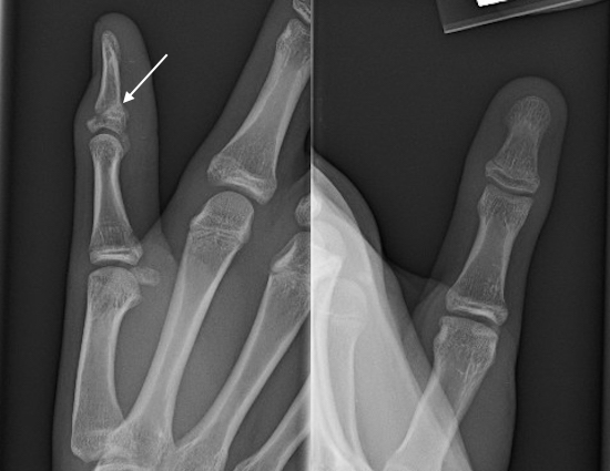 Thumb distal phalanx angulated Salter II fracture