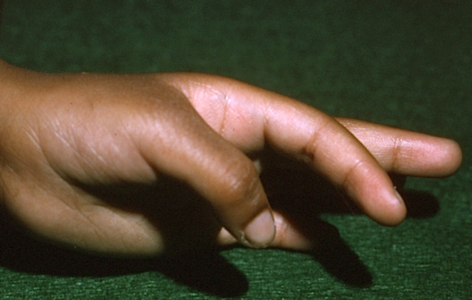 Thumb-in-palm (Clasped Thumb) secondary to cerebral palsy