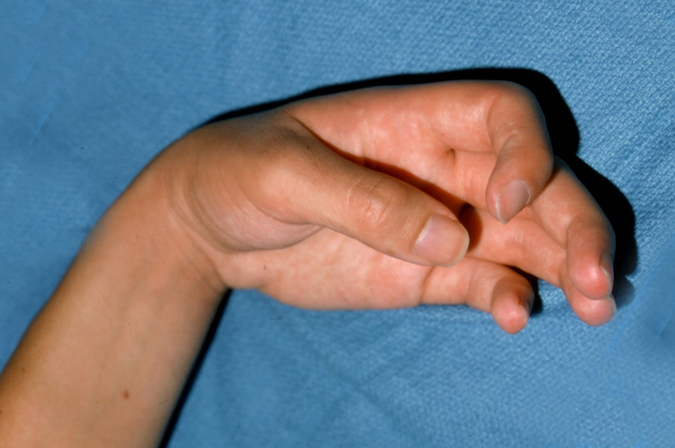 Thumb-in-palm (Clasped Thumb) secondary to traumatic brain injury