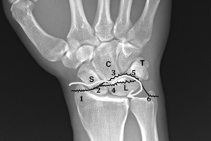 Greater arc carpal injuries are typically fracture/dislocations of radius, carpal bones, and ulnar styloid.  Fracture possibilities include radial styloid fractures (1); S-scaphoid fractures (2) which are associated with transscaphoid perilunate fracture/dislocations; C-capitate fractures (3); L-lunate fractures (4); T-triquetral fractures (5) and/or ulnar styloid fractures (6).  The white arrow shows the pathway of forces during a classic transscaphoid perilunate fracture dislocation.