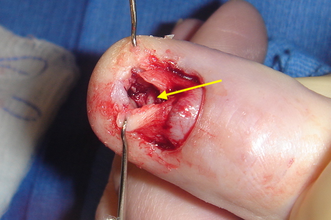 Sterile matrix split and fragmented distal phalanx cortex retracted ( hook) to expose abscess cavity in bone with granulation tissue (arrow).