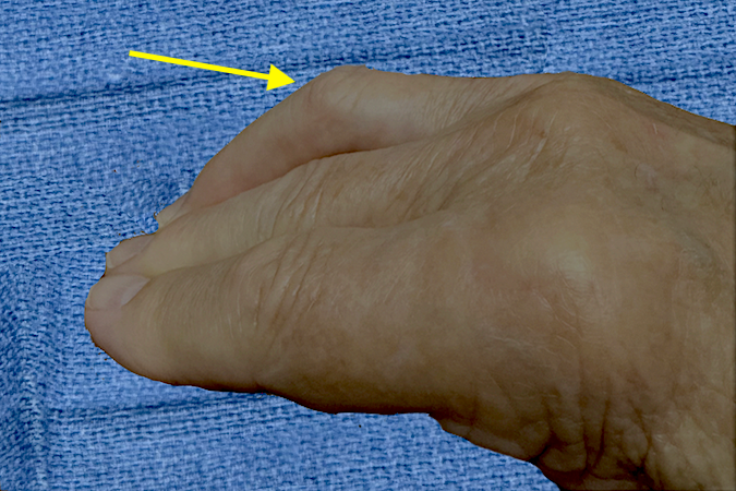 Chronic righr ring trigger finger in right handed 65 y.o. male.  Note the chronic secondary PIP joint mild flexion contracture (arrow).
