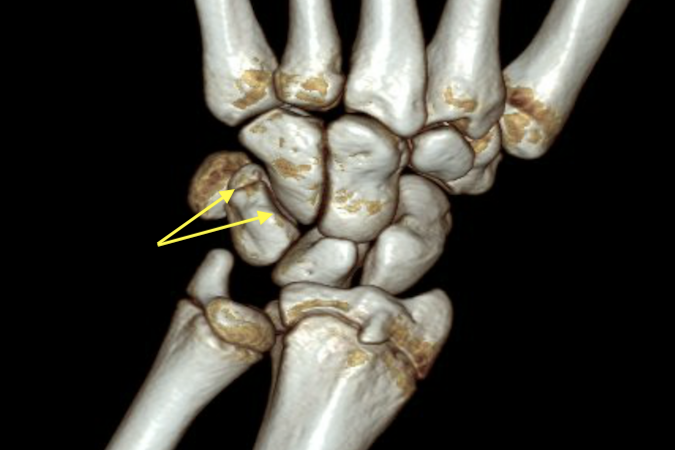 CT reconstruction with triquetral fracture (arrow)